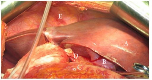 Transplantasi hati. Sumber: Openi, 2013.