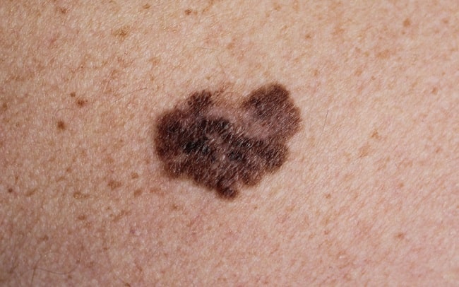 Nodular melanoma pada punggung. Sumber: C Washington, M Saraiya, PHIL CDC, 2007.