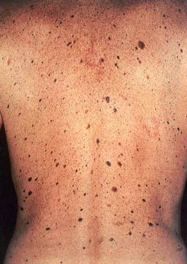 Nevi displastik multipel: faktor risiko melanoma. Sumber: C Washington, M Saraiya, PHIL CDC, 2007.