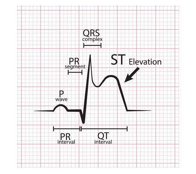 Unduh 9700 Gambar Hasil Ekg Yang Normal Terbaik Gratis