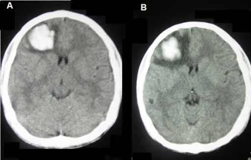 Ct Scan Kepala Indikasi Teknik Komplikasi Alomedika