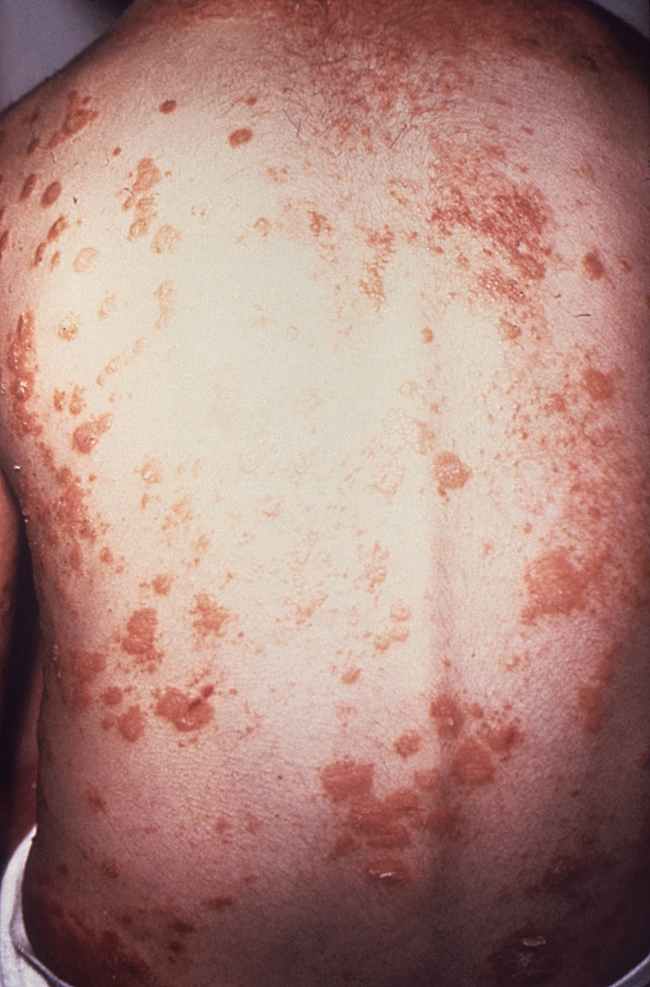 Psoriasis pada punggung. Sumber: anonim, PHIL CDC.