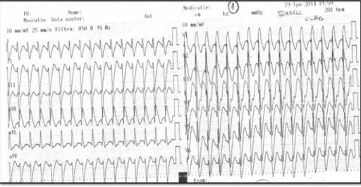 Gambaran EKG VT. Sumber: anonim, Openi, 2015.