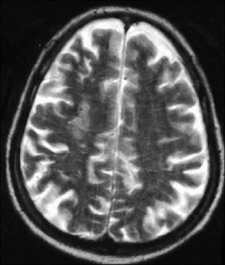 MRI 35 hari pasca stroke iskemik. Sumber: anonim, Openi, 2008.