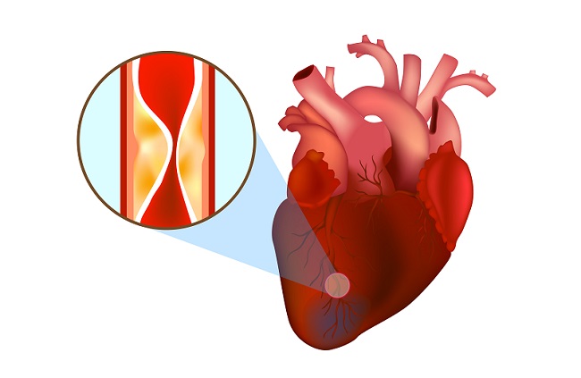 Coronary angiografi STEMI. Sumber: anonim, Openi, 2013.