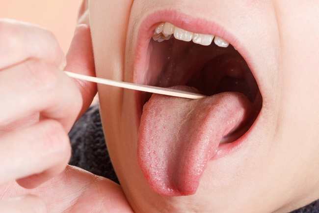 Tanda-tanda gejala termasuk demam, sakit tenggorokan, dan bintik-bintik kecil di mulut