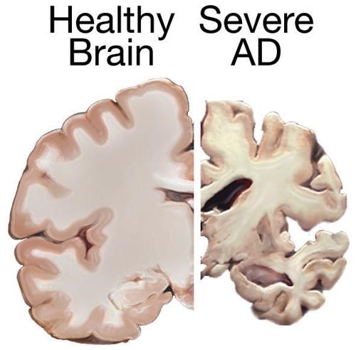 Atrofi otak pada penyakit Alzheimer berat. Sumber: WIkimediacommons, 2011