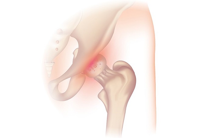 Sumber: Injurymap, Wikimedia commons, 2018.