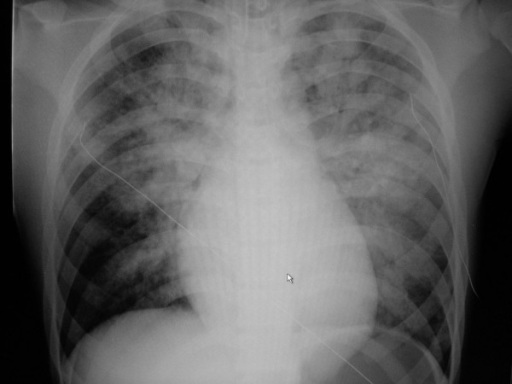 Edema paru akut bilateral. Sumber: anonim, Openi, 2009.