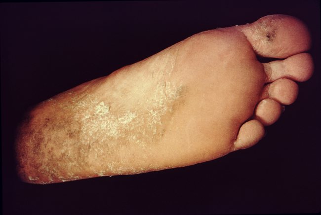 Tinea pedis telapak kaki kanan. Sumber: nn, PHIL CDC, 1975.
