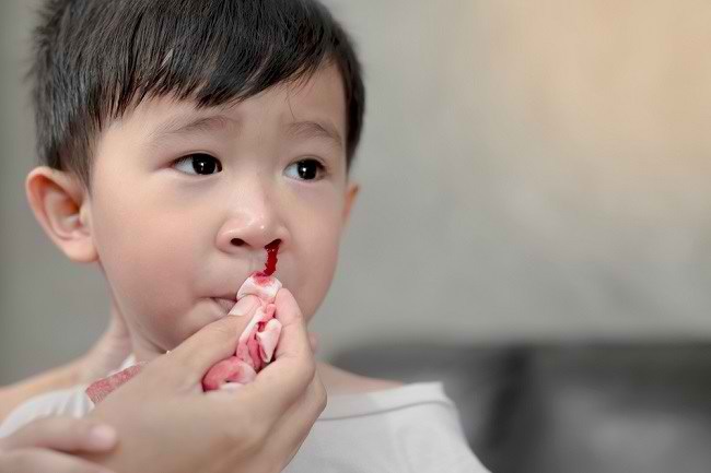 Tetap Tenang dalam Menyikapi Mimisan pada  Anak  Alodokter