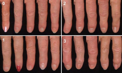 Gambaran grading osteoartritis sendi DIP kedua dekstral. Sumber: anonim, Openi, 2012.