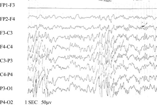 Gambaran EEG Kejang Demam. Sumber: anonim, Openi, 2014.