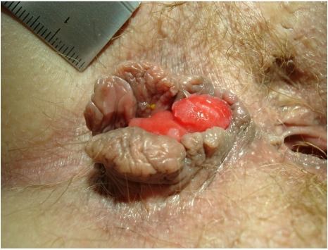 Hemorrhoid. Sumber: anonim, Openi, 2009.