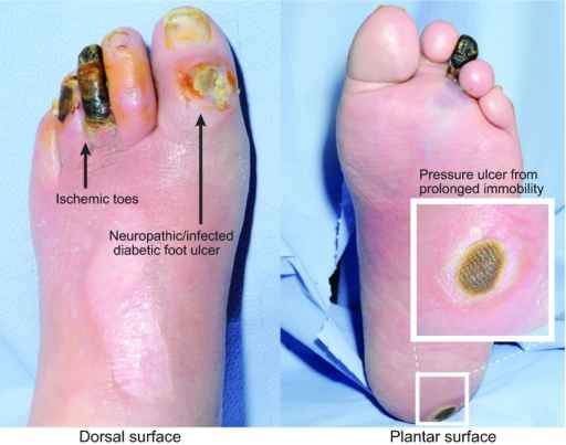 Ulkus diabetes. Sumber: Nunan R, Openi, 2014.
