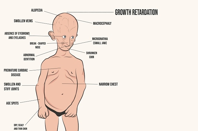 Progeria neonatal Neonatal progeria: