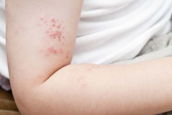 Staphylococcal Scalded Skin Syndrome Ssss Gejala Penyebab Dan Mengobati Alodokter