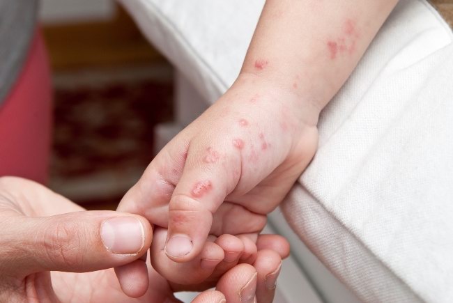 Impetigo Gejala Penyebab Dan Mengobati Alodokter