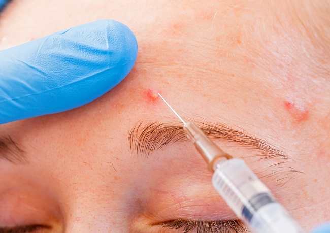 Acne injections to resolve stubborn acne