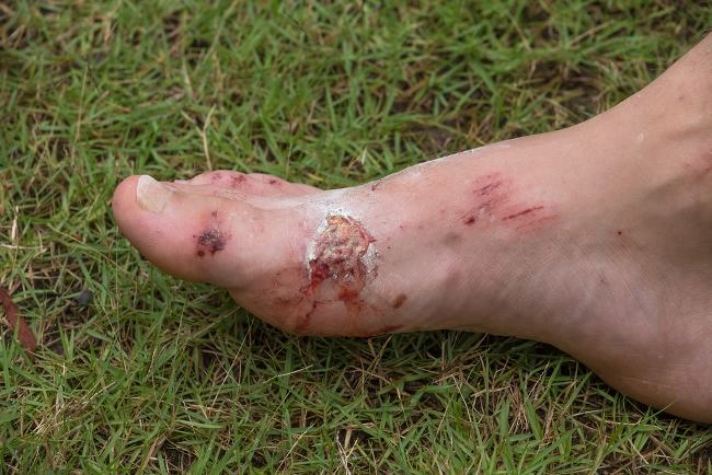 Gejala Infeksi Kulit Alodokter