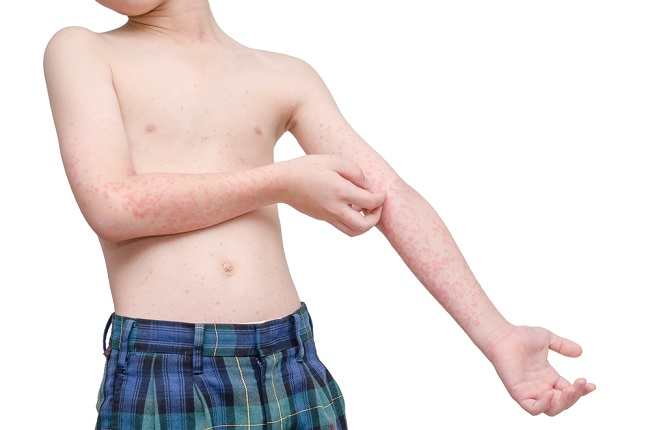 Gejala Alergi Dingin pada Anak dan Pencegahannya
