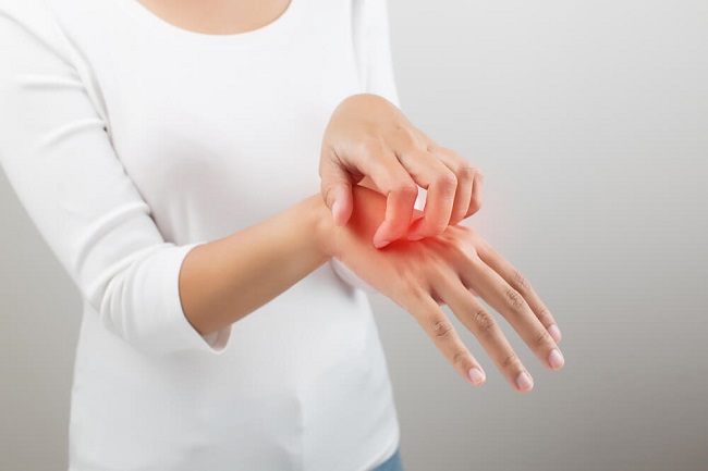 Mengenal dan Menangani Dermatitis Numularis yang Sering Dikira Kurap