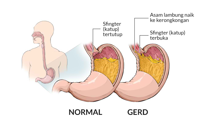 Asam Lambung Sering Kambuh