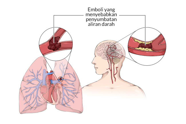 Hasil gambar untuk emboli paru