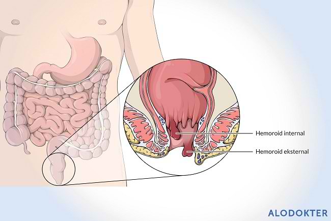  Penyebab Wasir  Hemoroid Alodokter