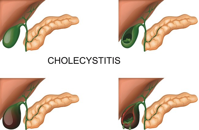 Kolesistitis Gejala penyebab dan mengobati Alodokter