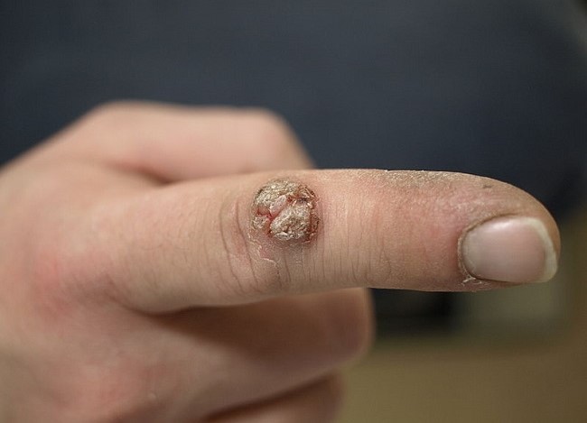 almaecet és hpv a genitális szemölcsök első szakasza