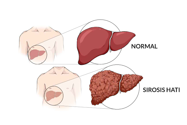 penyakit sirosis hati bisa sembuh