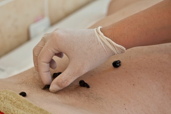 diabetes pengobatan lintah untuk diabetes pengobatan lintah untuk