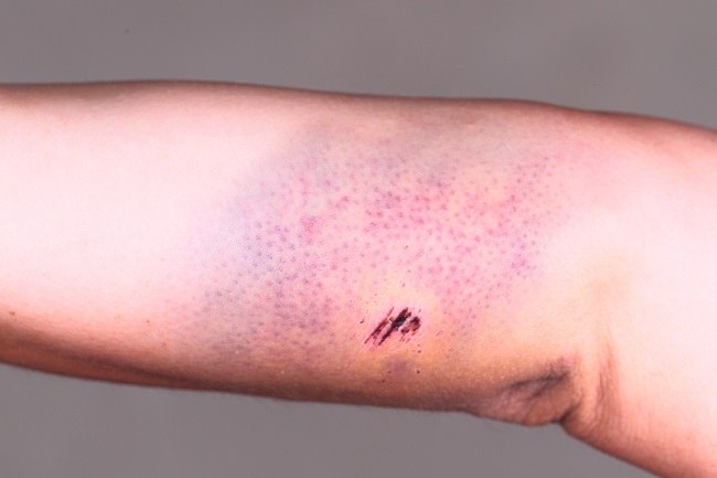 Hematoma - alodokter