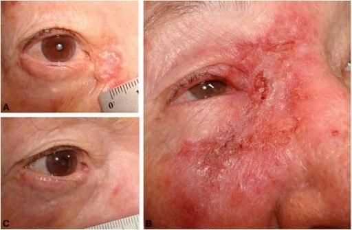 Karsinoma sel basal tipe nodular. Sumber: Openi 2015