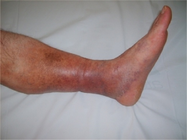 Gambar 1. Deep Vein Thrombosis. Sumber : Seyahi E, Yurdakul S, Openi, 2011.