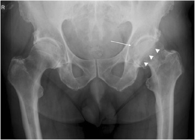 Gambar 1. Osteoarthritis panggul. Sumber : Openi, 2016