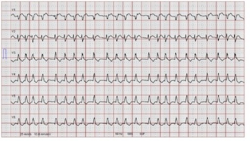 Unduh 560 Gambar Hasil Ekg Jantung Tidak Normal Paling Bagus Gratis