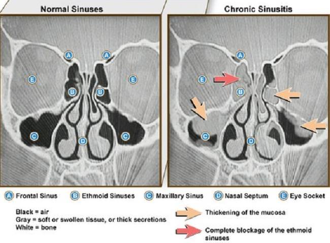 Gambar 1. Perbedaan gambaran CT Scan pada sinus normal dan sinusitis. Sumber : NIAID, Wikimedia Commons, 2011