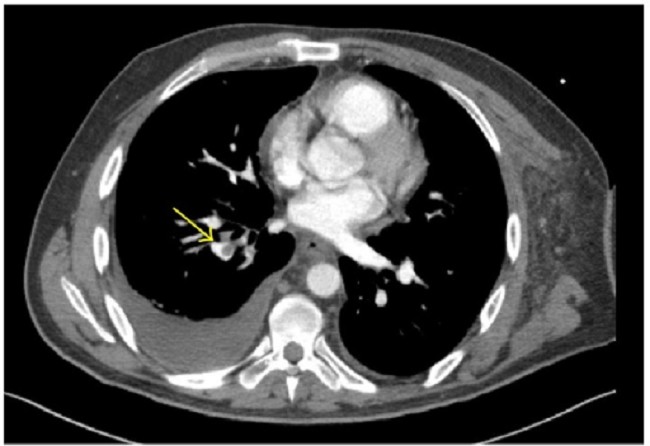 Gambar 1. CT angiografi embili paru (Sumber : openi, 2014)