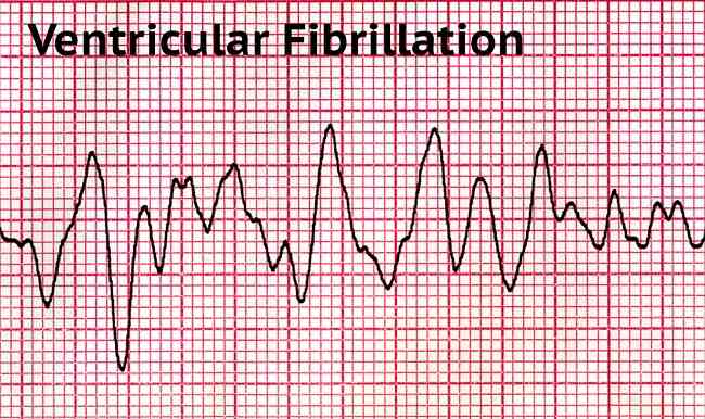 Diagnosis Fibrilasi Ventrikel Alomedika