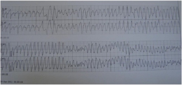 Diagnosis Fibrilasi Ventrikel Alomedika