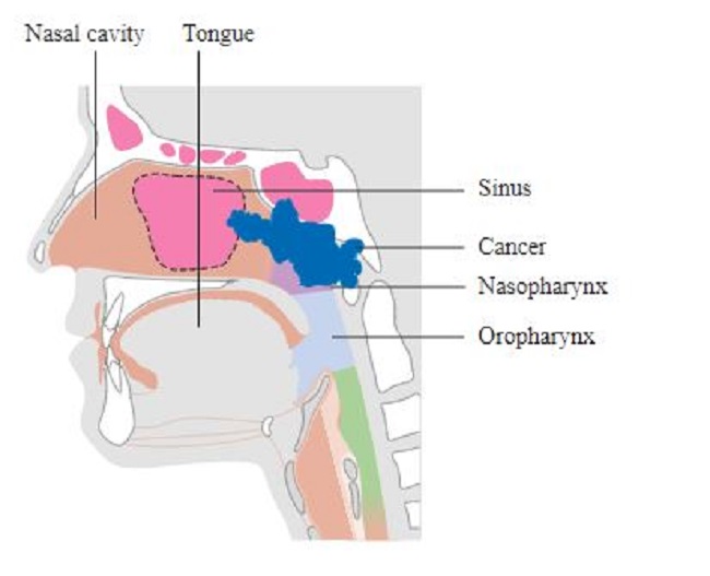 Gambar 1. Diagram Kanker Nasofaring (Sumber : Cancer Research UK, Wikimedia Commons, 2014)