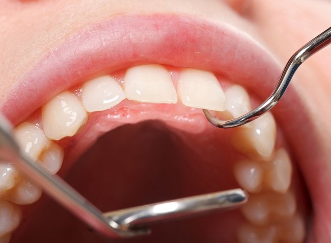 Here's how to get rid of plaque on teeth