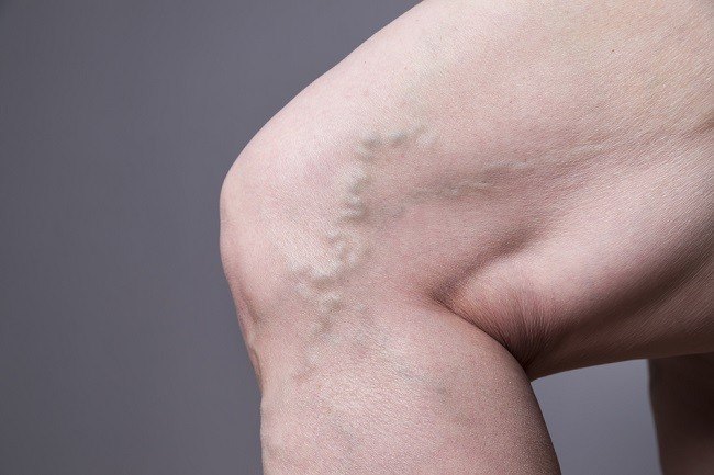 mijloace pentru prevenirea i tratamentul varicozei cum sa eliminai umflarea de la varicoza