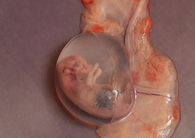 Diagnosis Abortus Alomedika