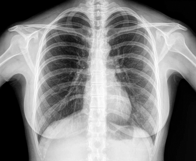 Mengetahui Kondisi Tubuh dengan Pemeriksaan X-Ray - Alodokter
