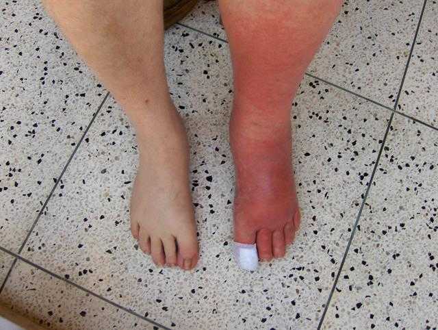 Selulitis kaki kiri. Sumber: ColmAnderson, Wikimedia commons, 2006.