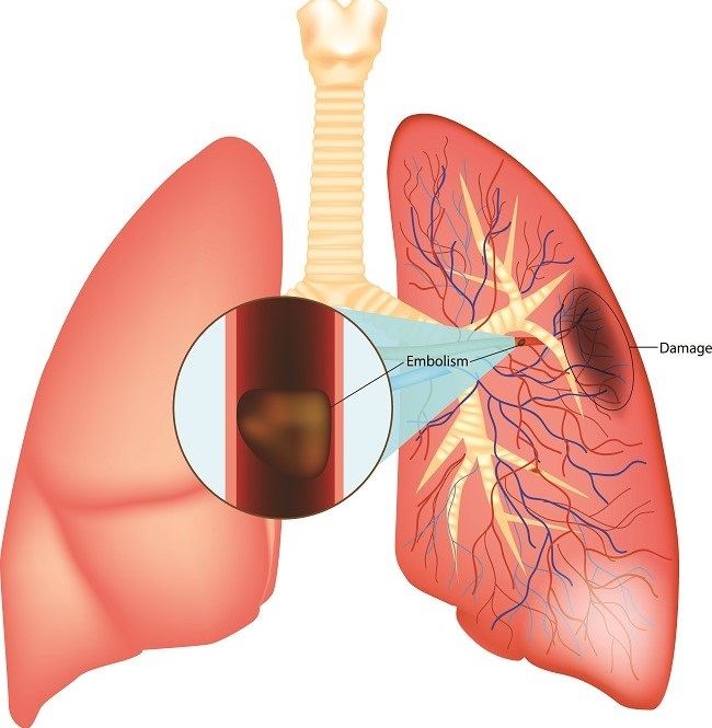 Hasil gambar untuk emboli paru