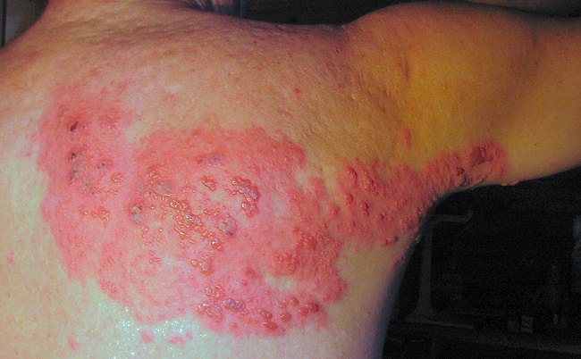 Gambar 1. Ruam herpetiform pada herpes zoster (Sumber : Fisle, Wikimedia commons, 2007)